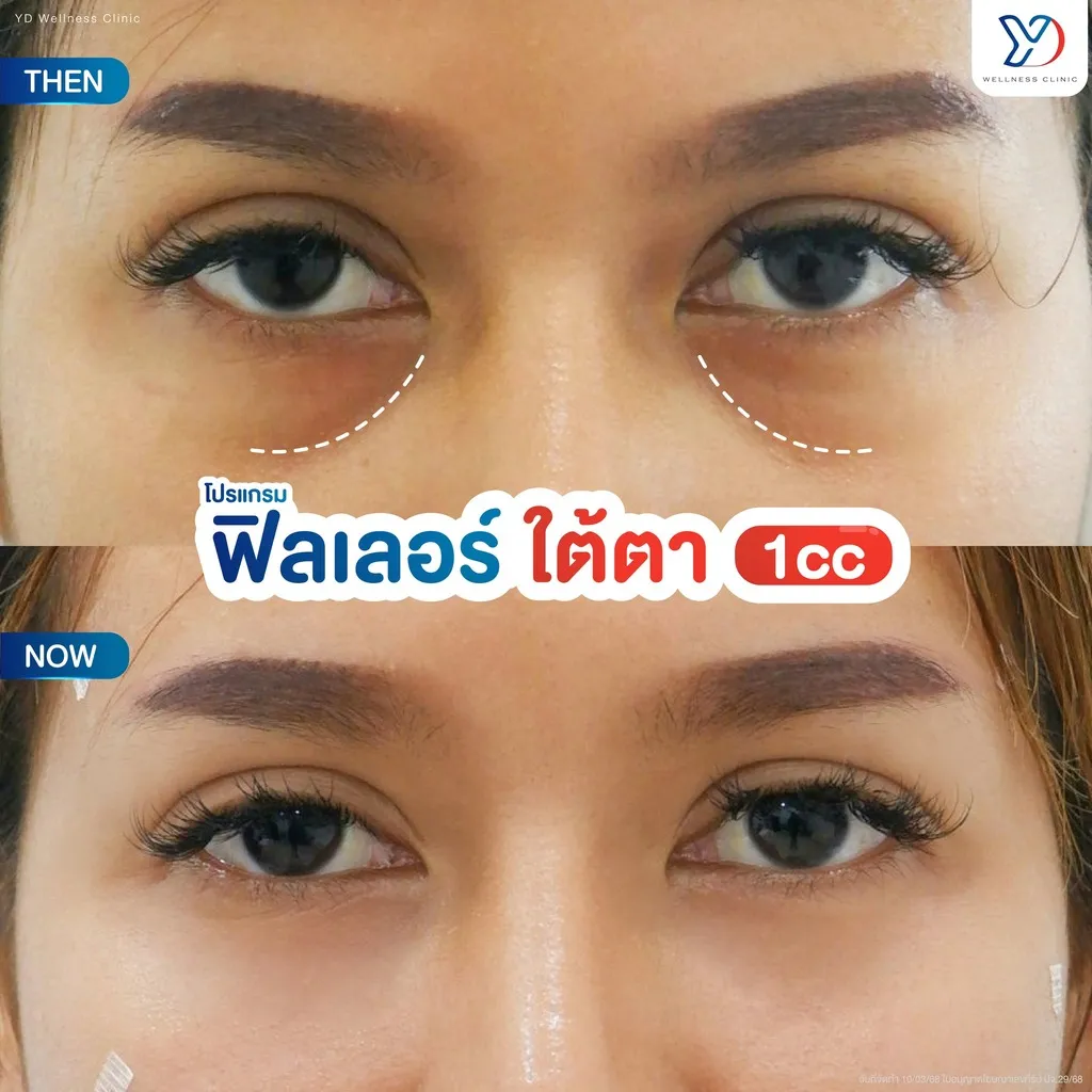 แก้ใต้ตาเป๊ะใน 1 ซีซี