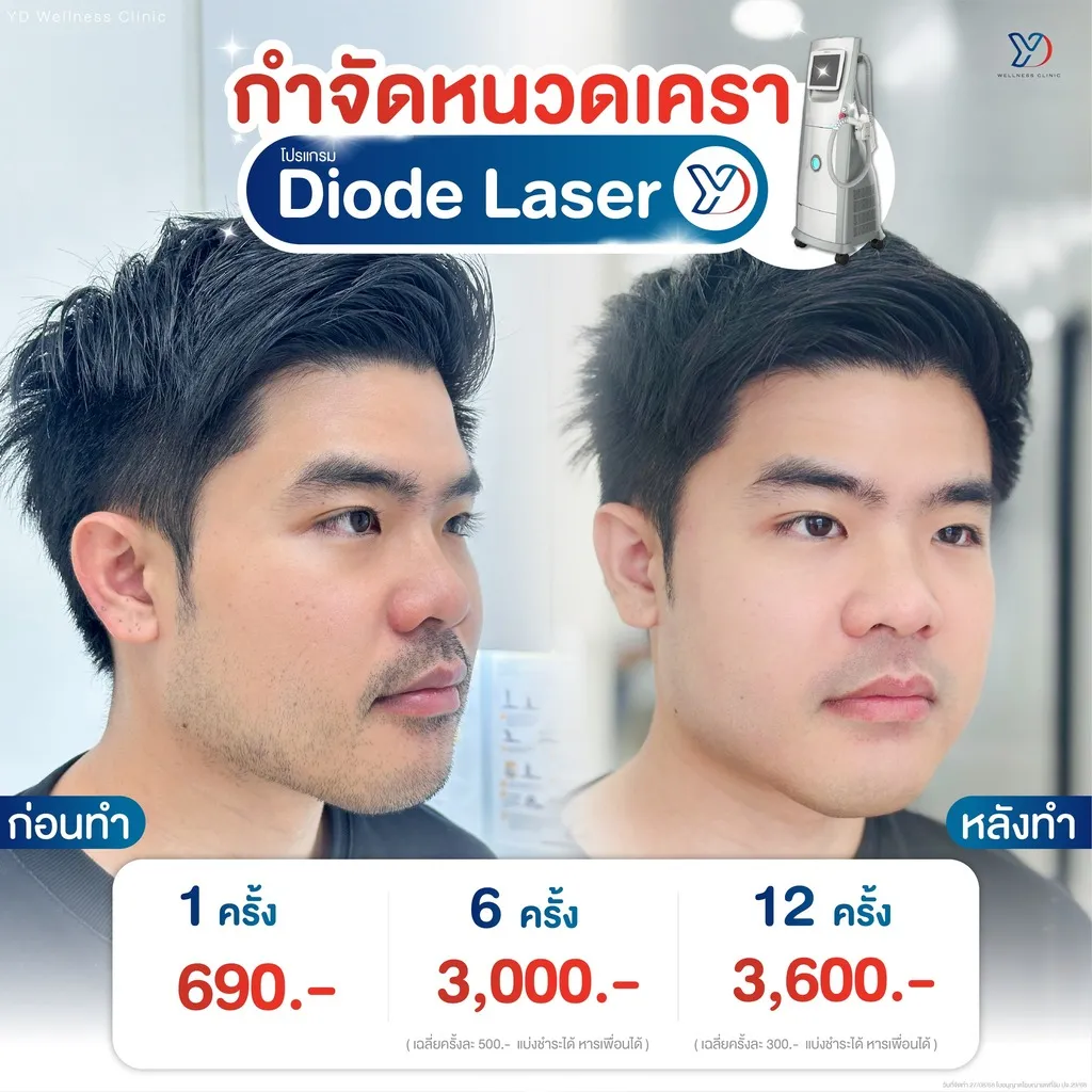 โปรฯ กำจัดหนวดเครา