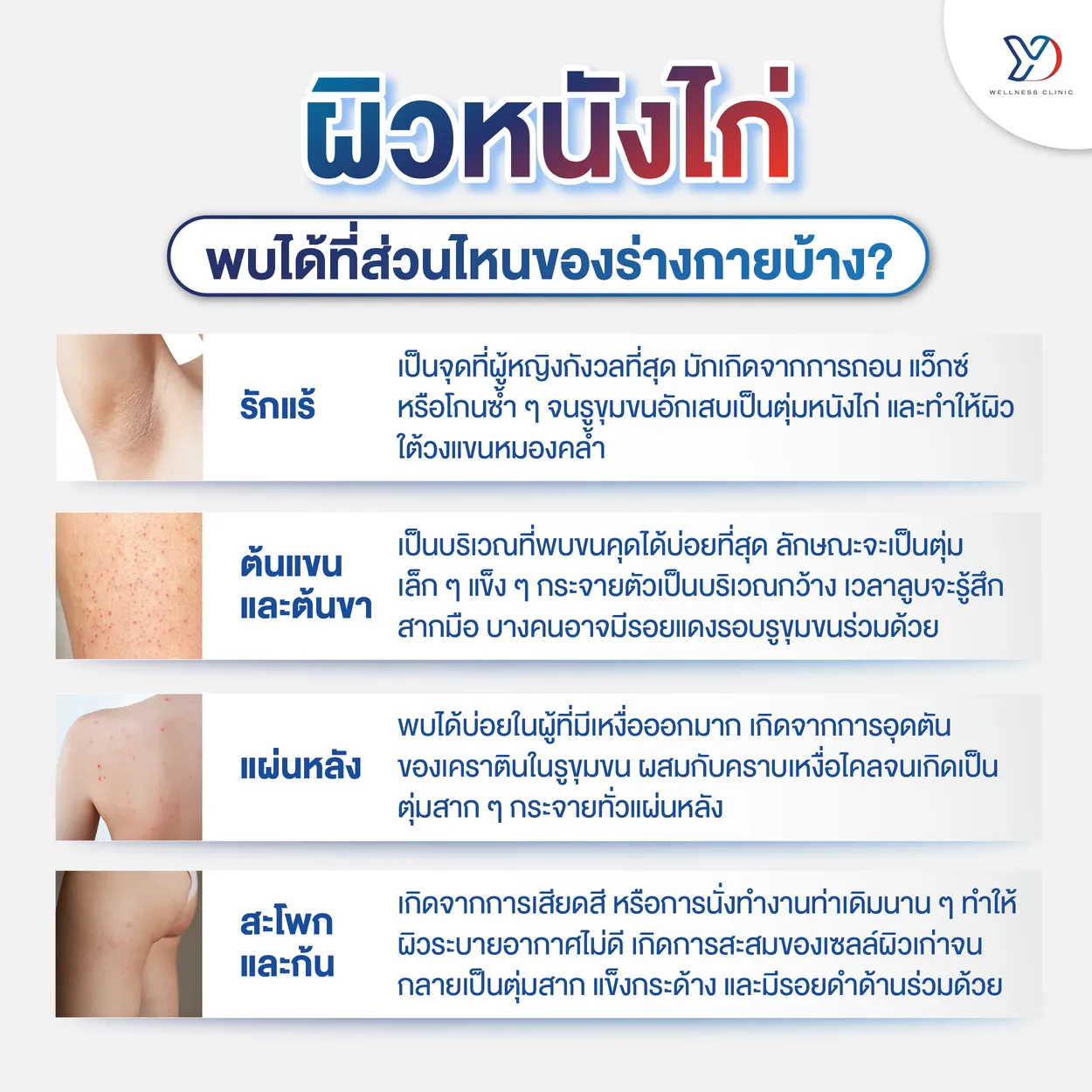 ผิวหนังไก่พบได้ที่ส่วนไหนของร่างกายบ้าง?