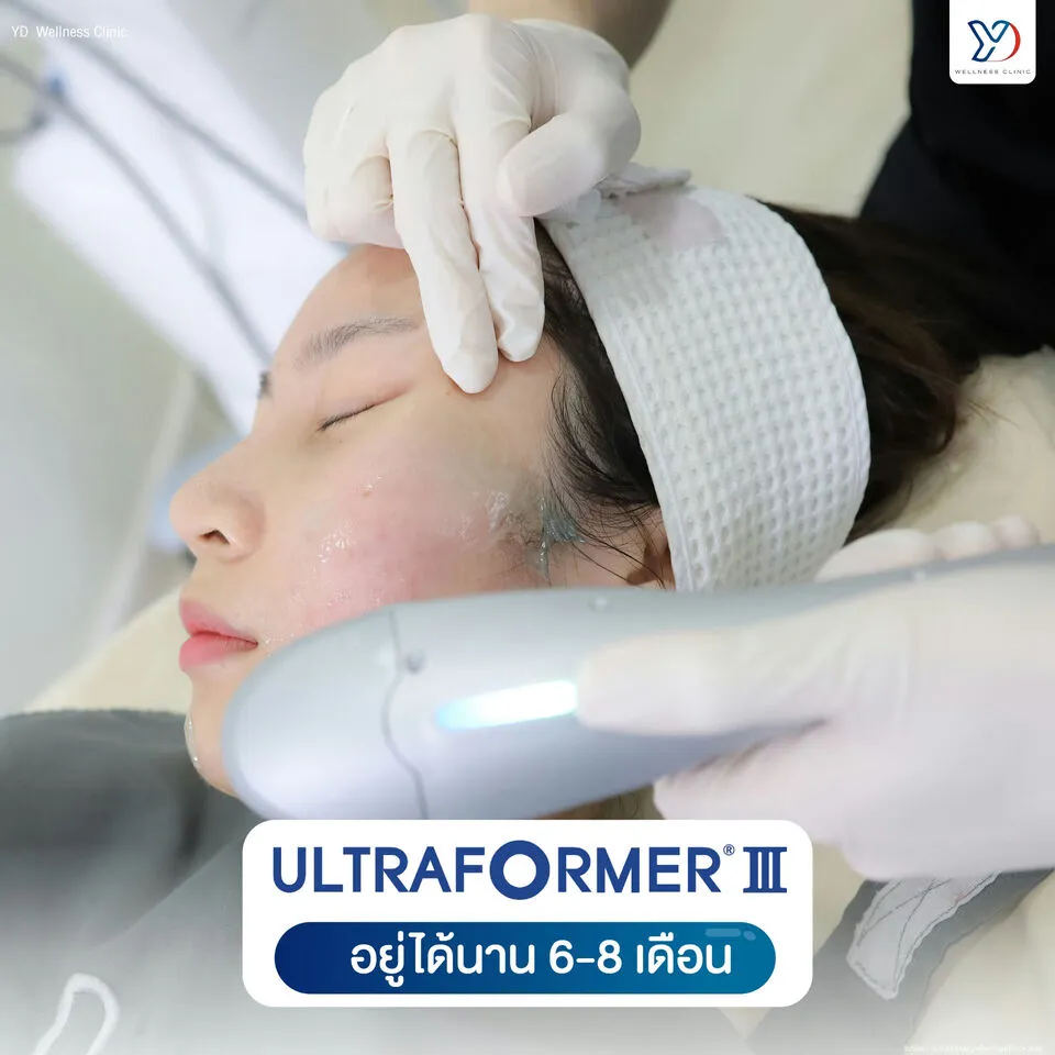 Ultraformer III อยู่ได้นาน 6-8 เดือน