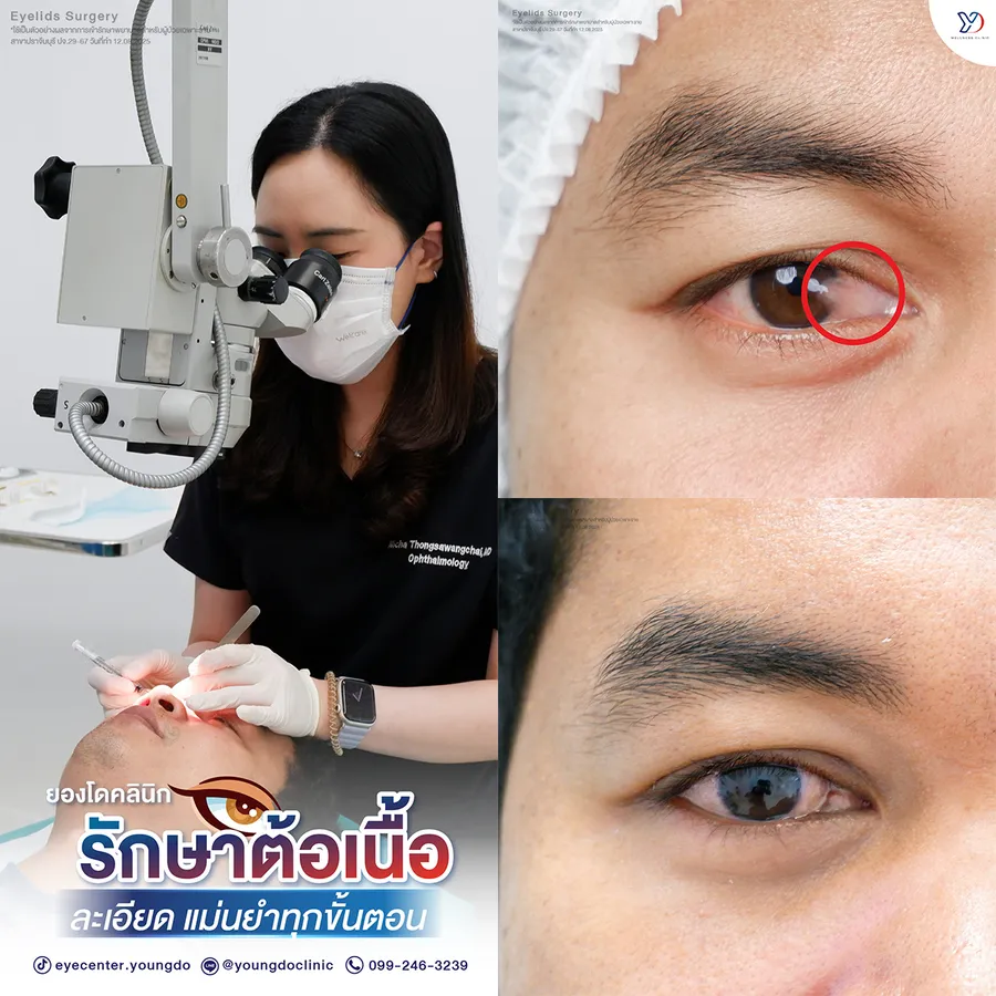 รักษาต้อเนื้ออย่างแม่นยำ