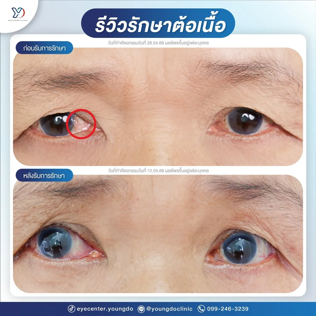 รีวิวรักษาต้อเนื้อ (ผู้สูงอายุ)