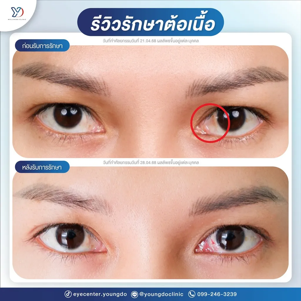 รีวิวรักษาต้อเนื้อ (วัยทำงาน)