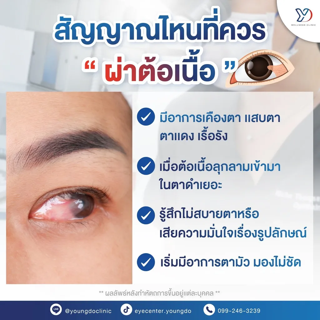 เช็กสัญญาณเตือนต้อเนื้อ