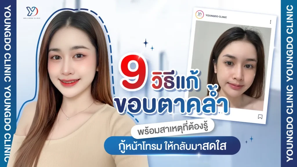 9 วิธีแก้ขอบตาคล้ำ รู้สาเหตุให้ชัด กู้หน้าโทรมให้ตาสดใสเห็นผลจริง