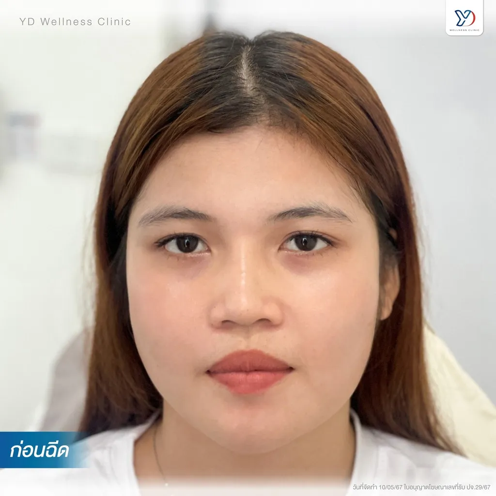 สภาพกล้ามเนื้อกรามก่อนการรักษา