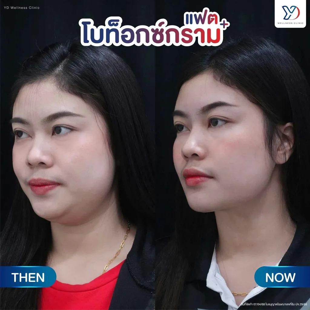 โปรโมชั่นร่วมโบท็อกซ์กรามและฉีดเมโสแฟต