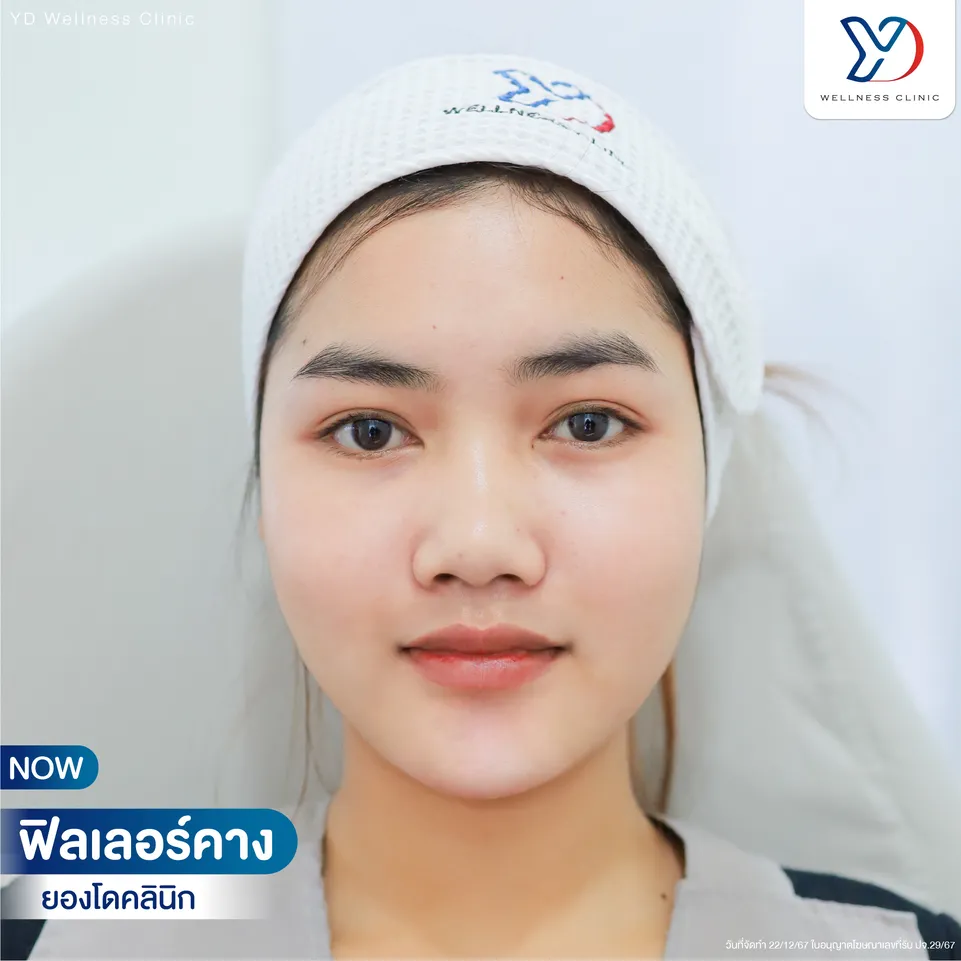 รีวิวผลลัพธ์หลังการฉีดฟิลเลอร์คาง