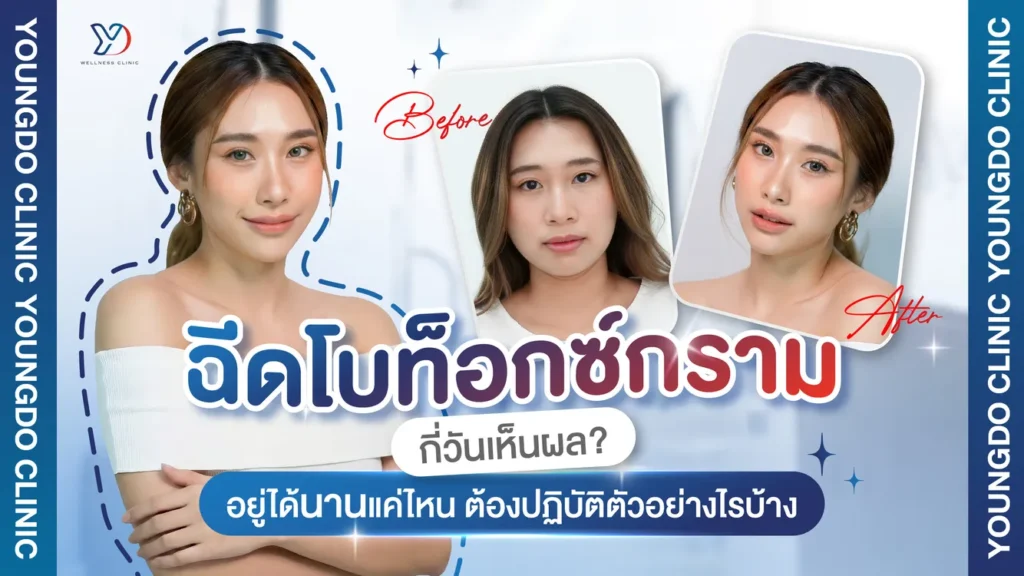 โบท็อกซ์กราม กี่วันเห็นผล อยู่ได้นานแค่ไหน และต้องดูแลตัวอย่างไร