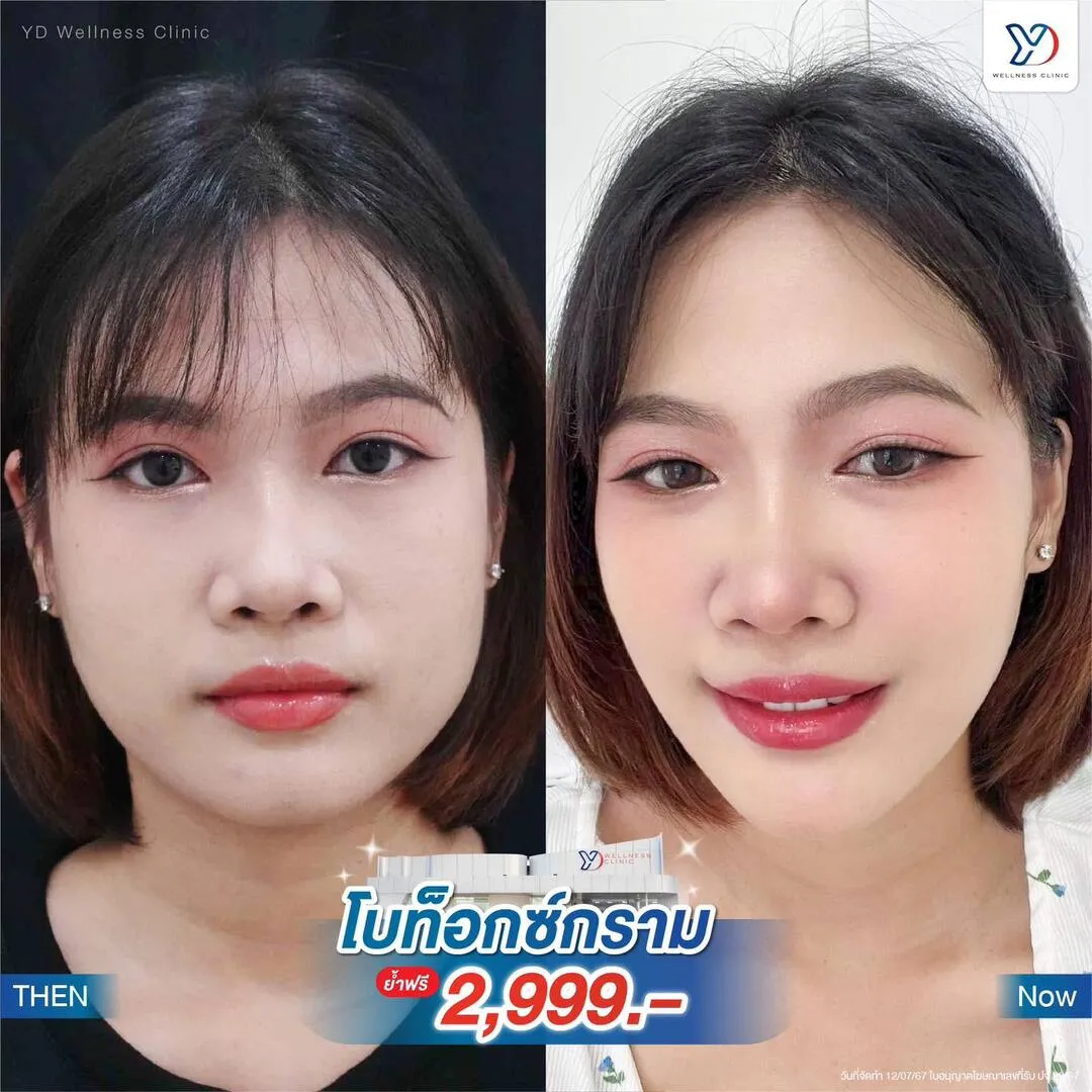 การเปลี่ยนแปลงรูปหน้าสู่ V-Shape