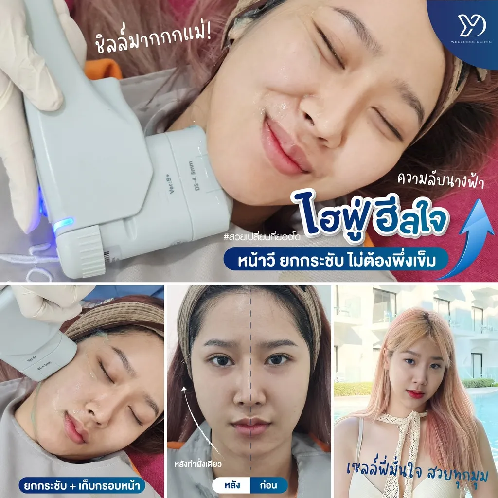 การยกกระชับใบหน้าด้วย HIFU