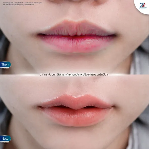 ก่อนและหลังทำปากกระจับ-03