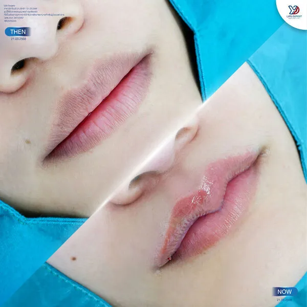 ก่อนและหลังทำปากกระจับ-02