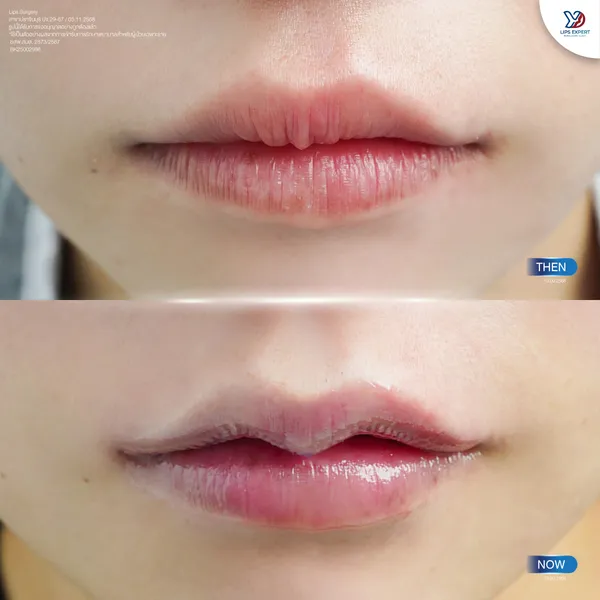 ก่อนและหลังทำปากกระจับ-01