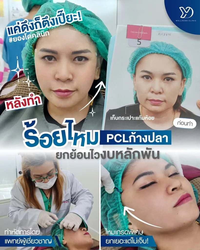 ผลลัพธ์การยกกระชับผิวด้วยไหม PCL-01
