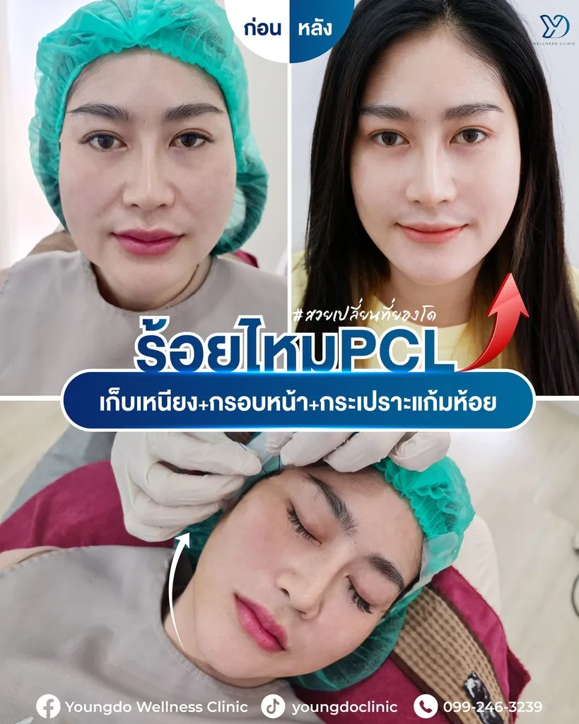ผลลัพธ์การยกกระชับผิวด้วยไหม PCL-02