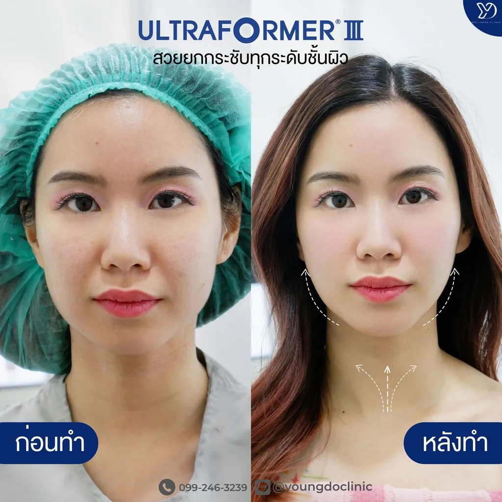 ผลลัพธ์จากการยกกระชับใบหน้าด้วยเครื่อง Ultraformer III