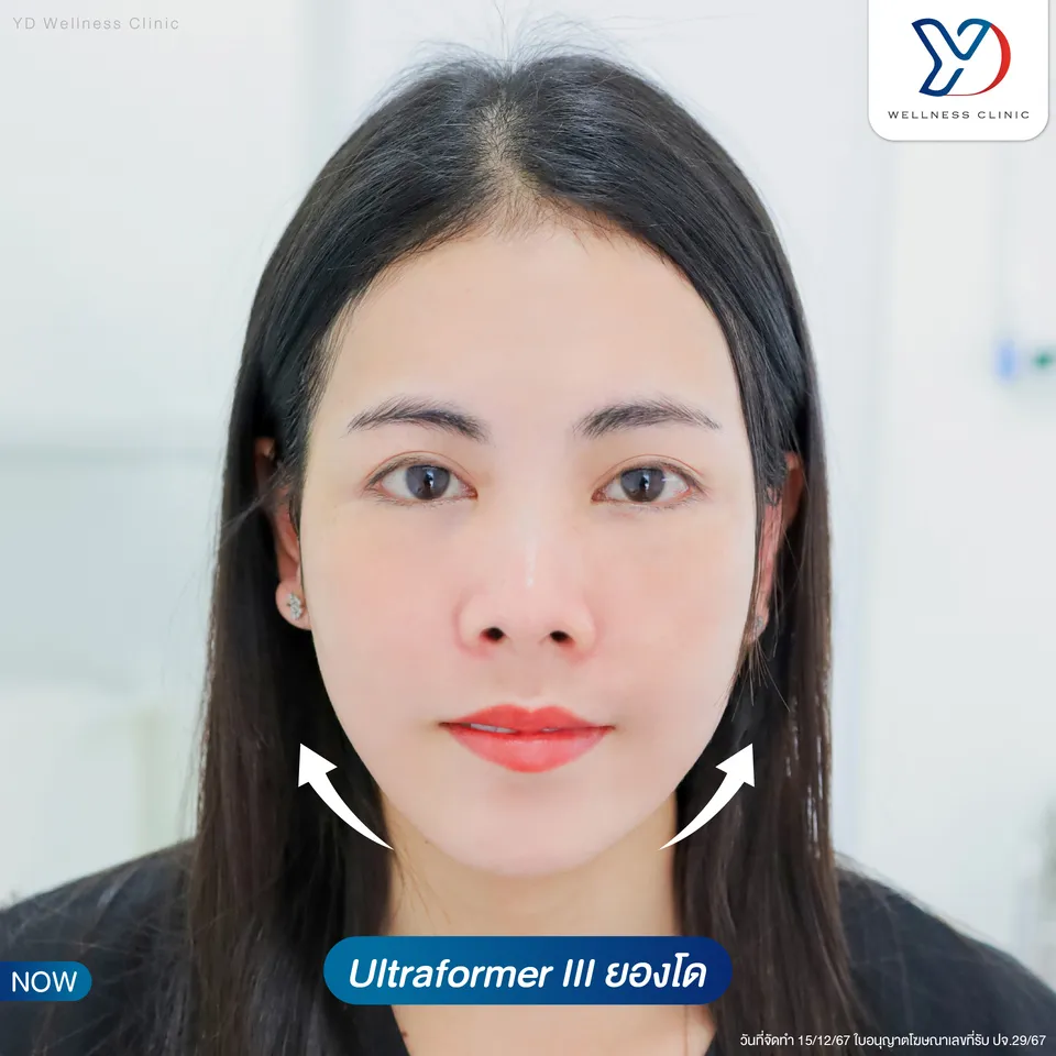ยกกระชับใบหน้าด้วย Ultraformer III