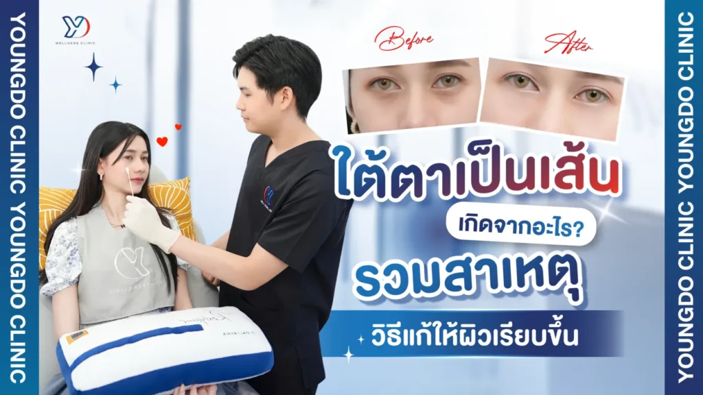 ใต้ตาเป็นเส้น เกิดจากอะไร รวมสาเหตุและวิธีแก้ให้ผิวใต้ตาเรียบขึ้น