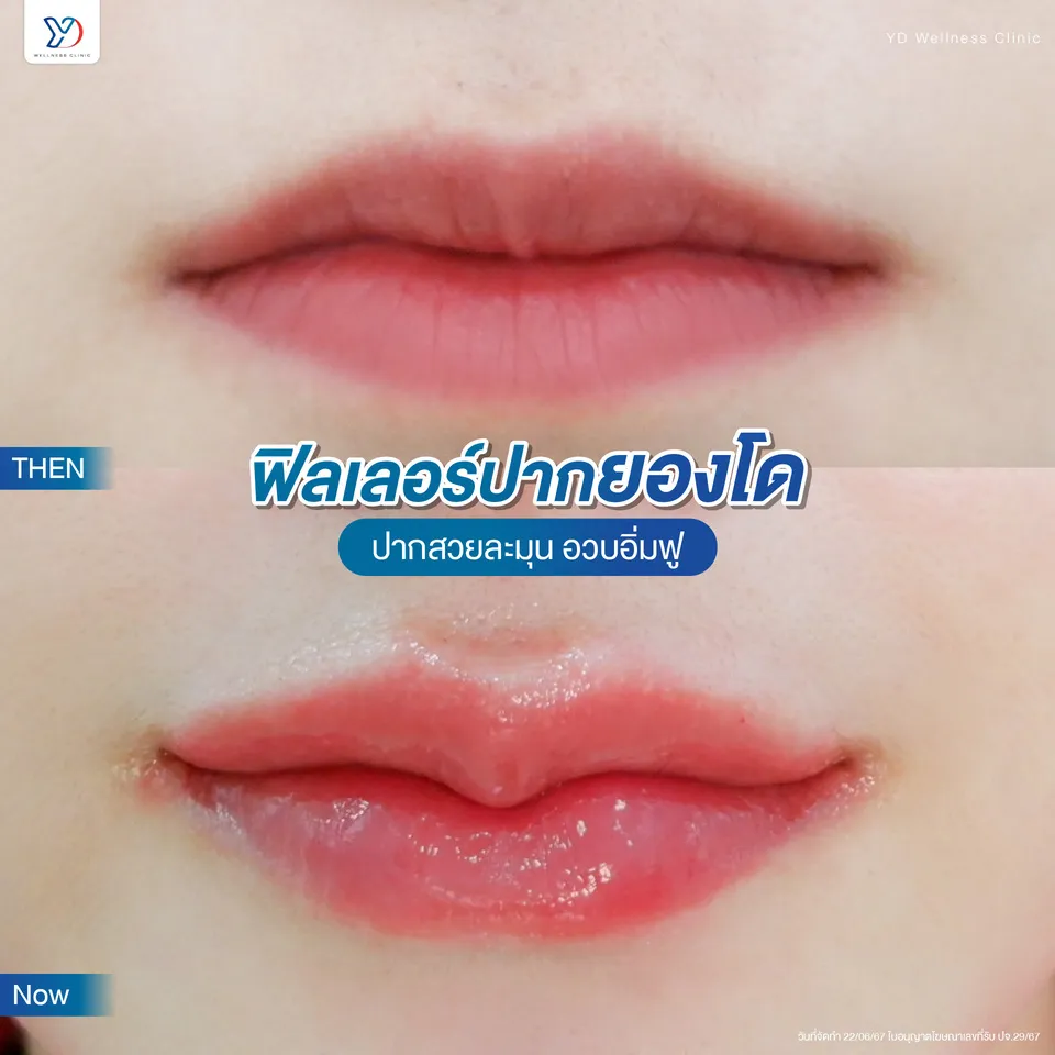 ผลลัพธ์จากการฉีดฟิลเลอร์ปาก Youngdo