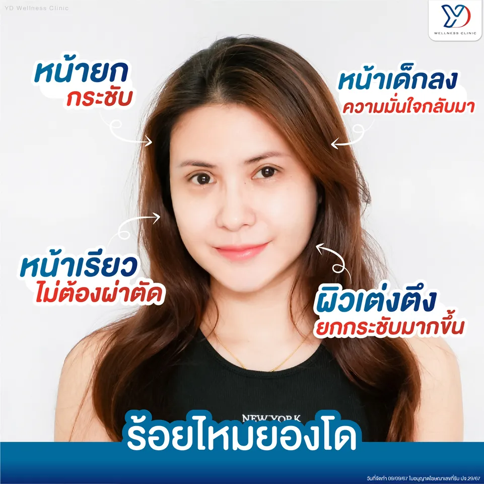 ผลลัพธ์การยกกระชับผิวด้วยไหม Youngdo