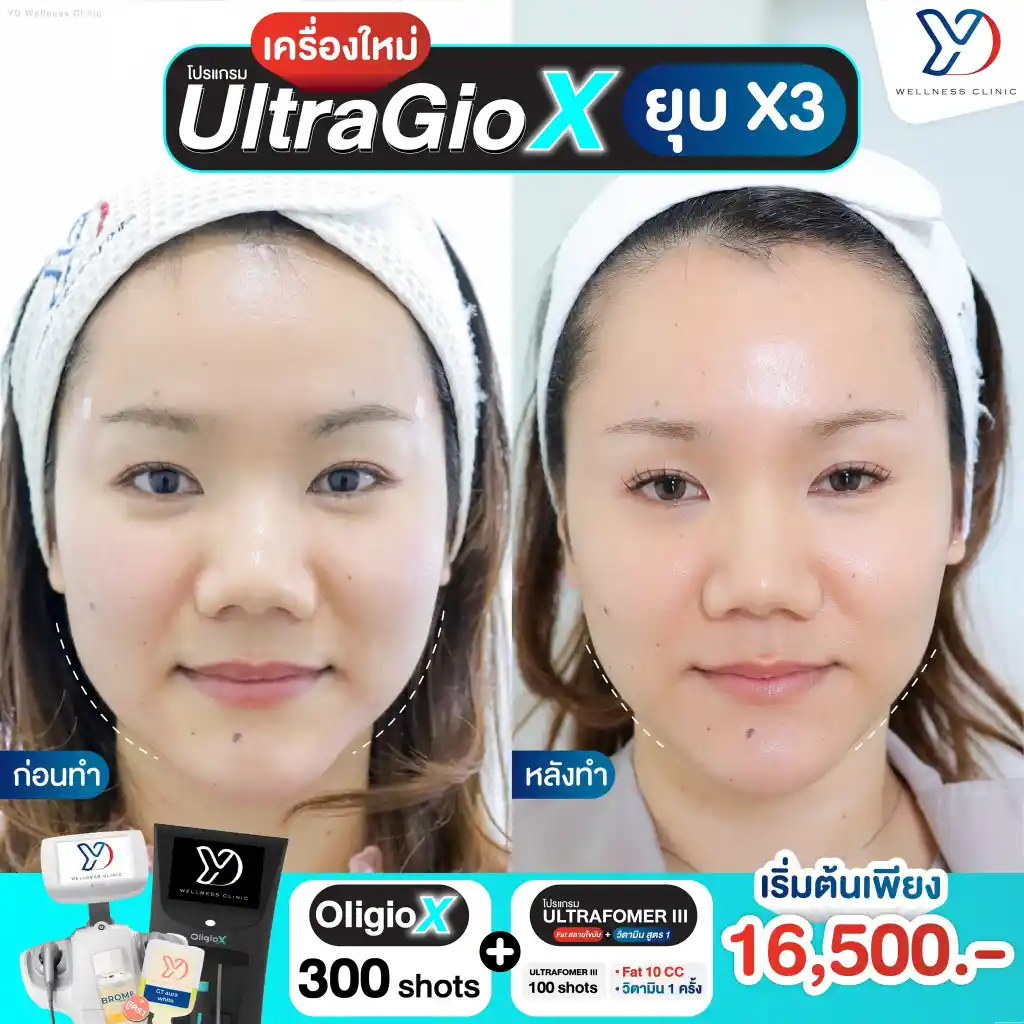 UltraGio X ปราจีน แก้ปัญหาจุดไหนได้บ้าง