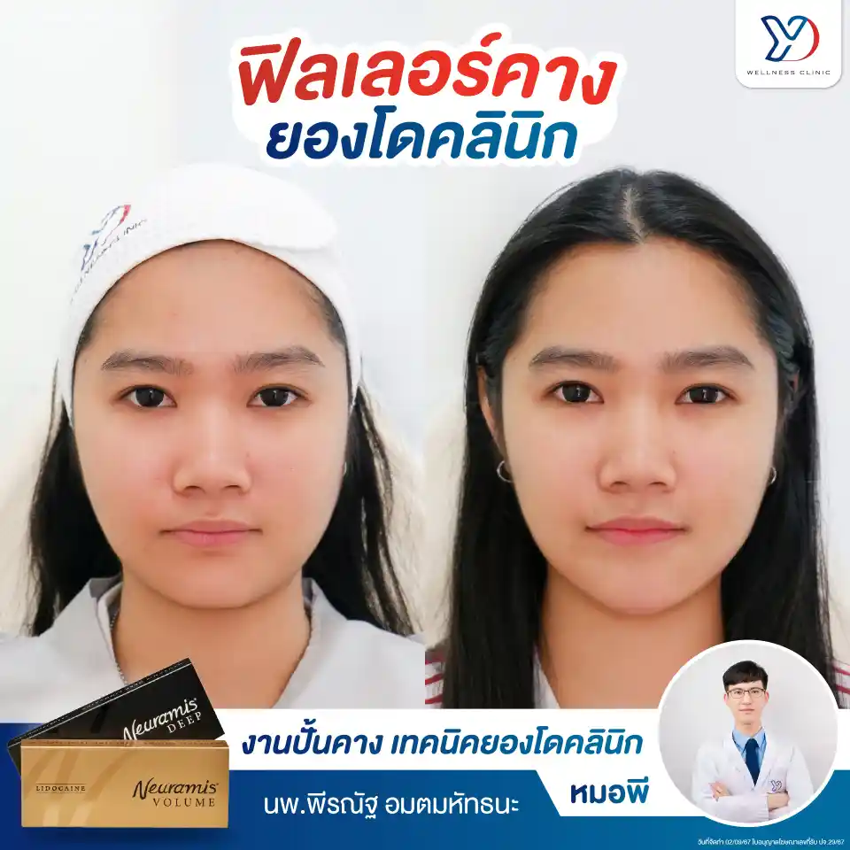 ฟิลเลอร์ Neuramis คือ