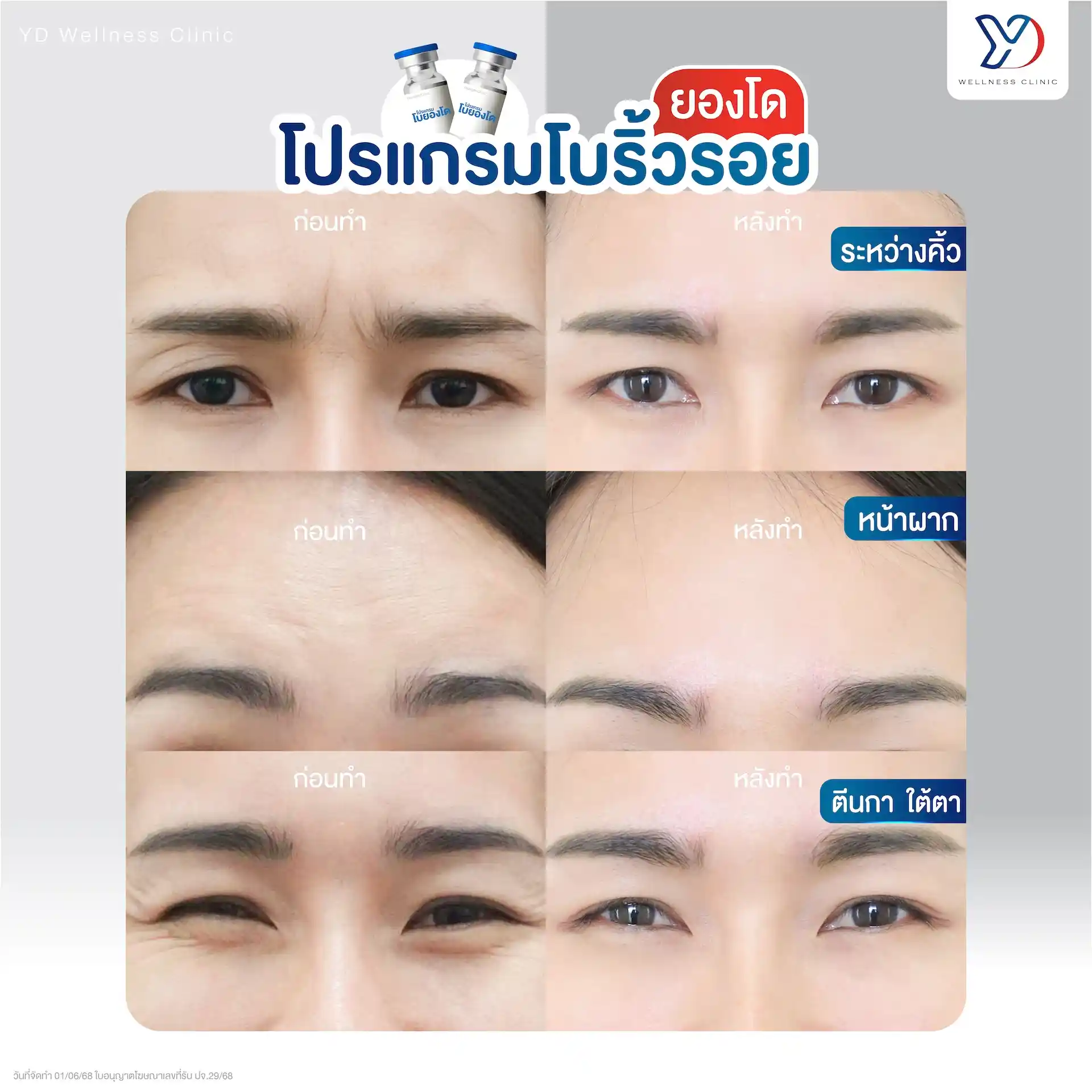 Baby Botox ช่วยแก้ปัญหาอะไรได้บ้าง
