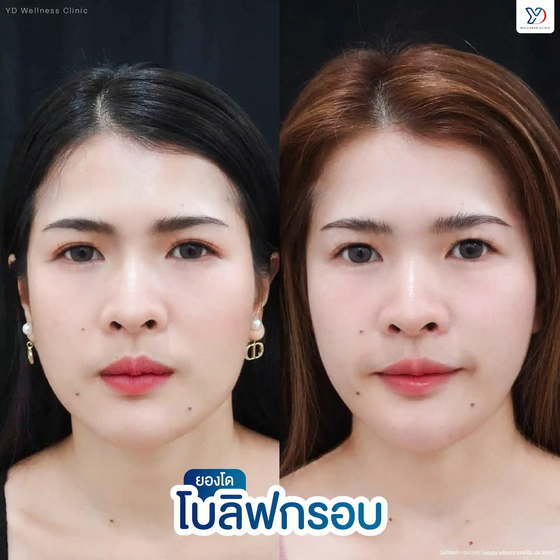 การฉีดโบลิฟกรอบหน้า ช่วยแก้ปัญหาอะไรได้บ้าง
