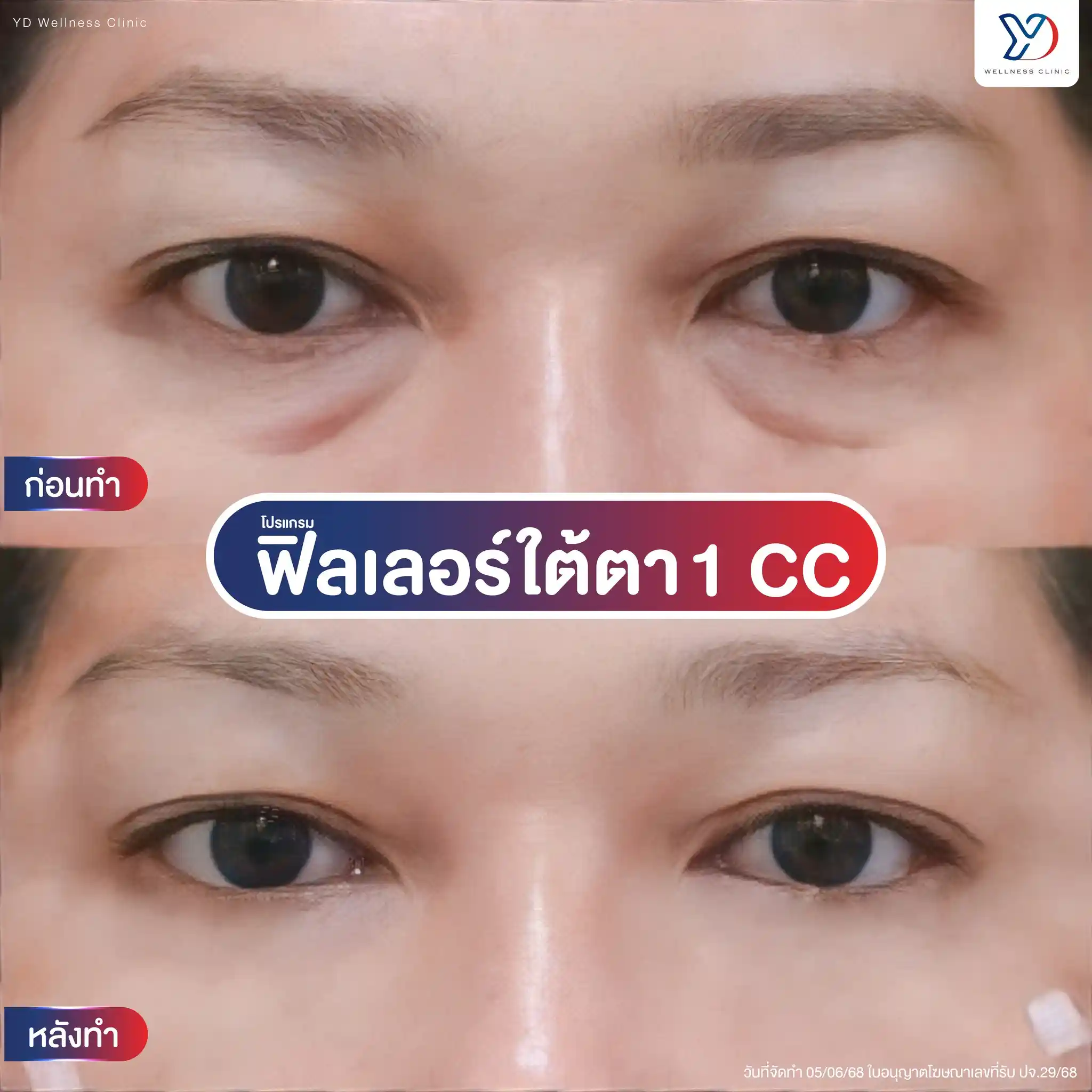 สาเหตุที่ทำให้ใต้ตาเหี่ยวมีอะไรบ้าง