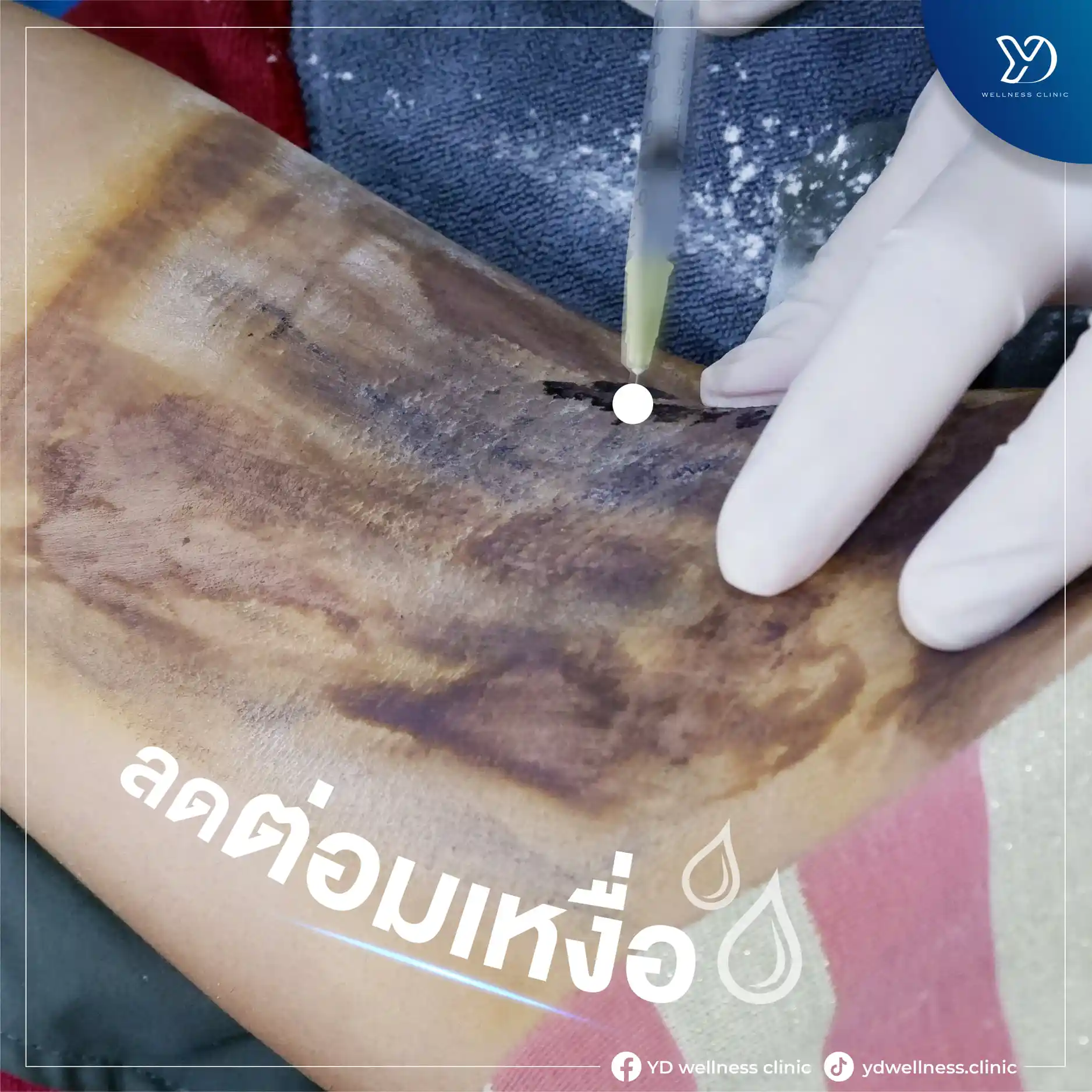 วิธีแก้รักแร้เปียกทางการแพทย์