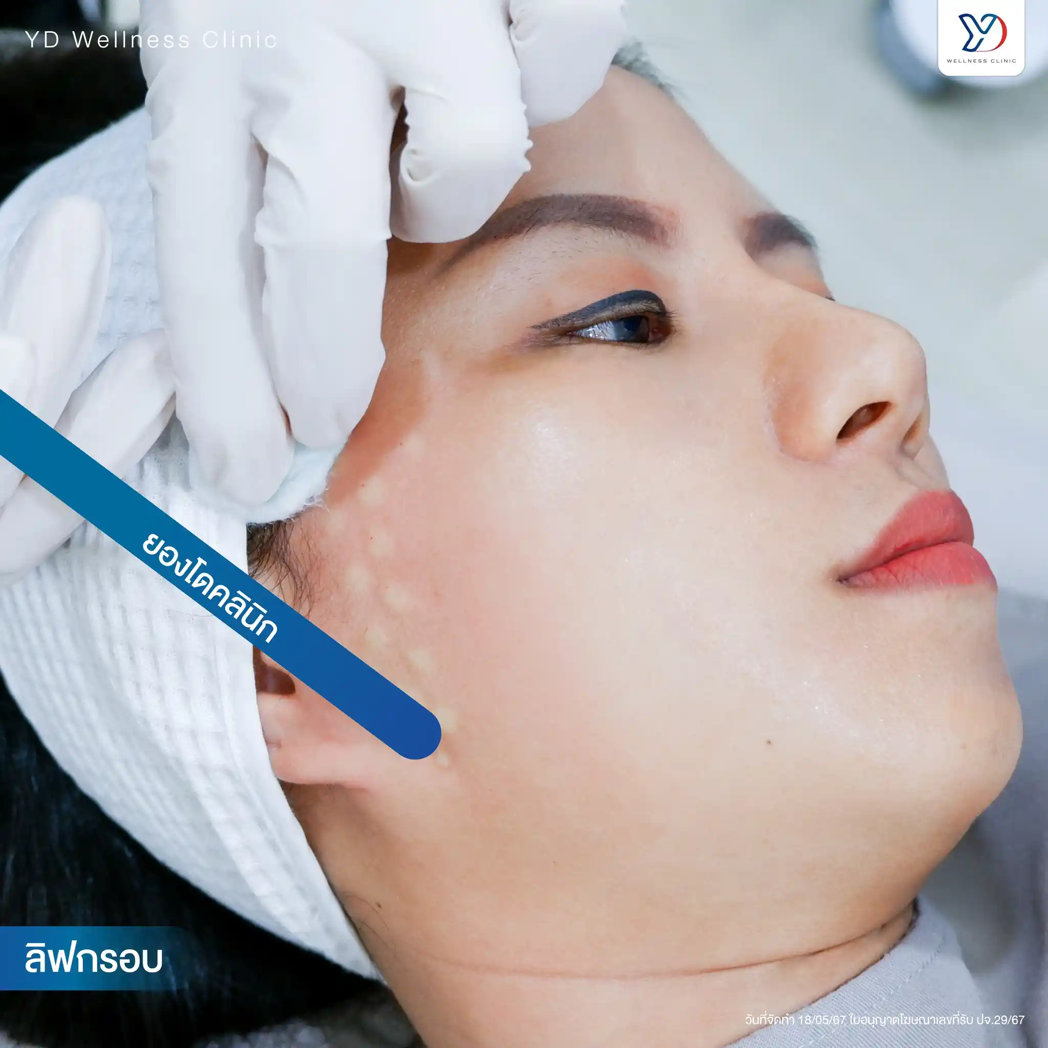 popular-injection-areas-for-jawline-botox-lifting