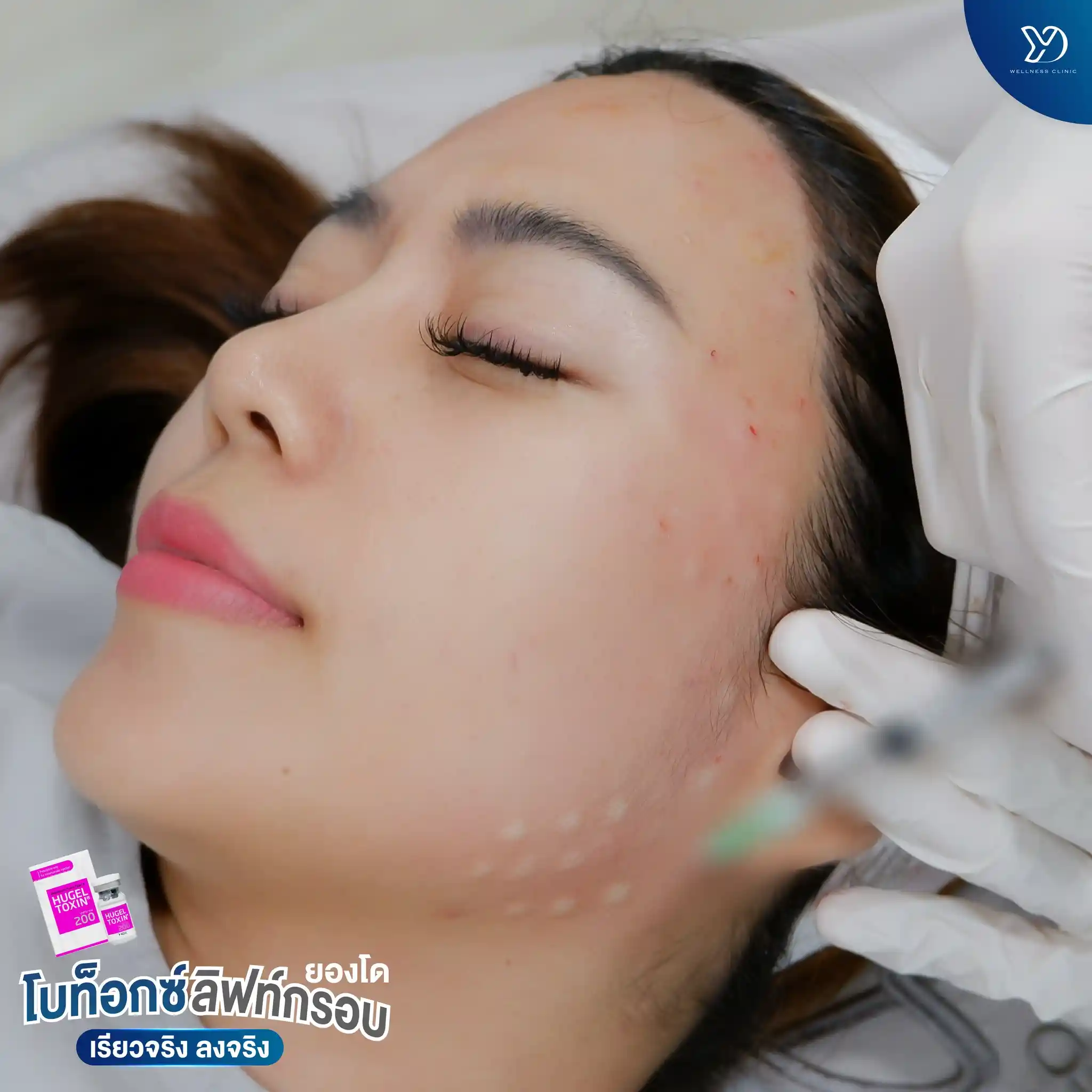 ฉีดโบลิฟกรอบหน้า ปราจีน คืออะไร