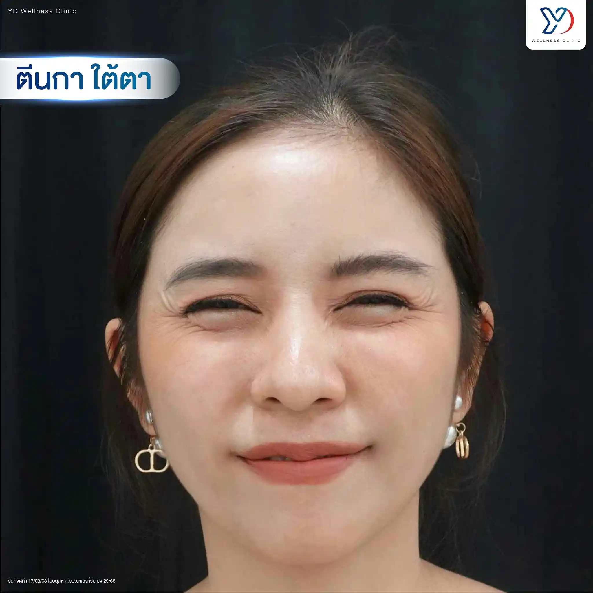 Baby Botox เหมาะกับใครบ้าง