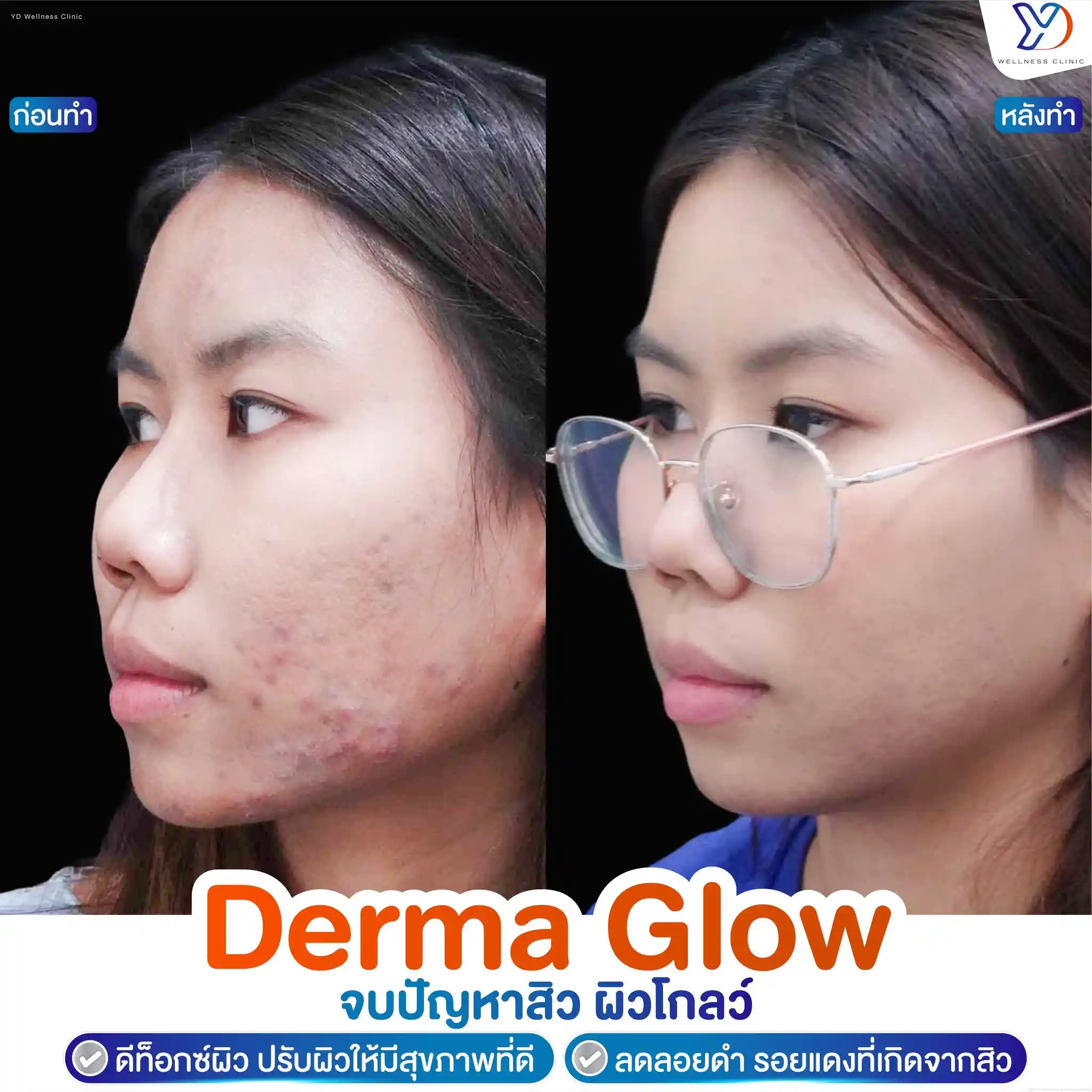 วิธีรักษาหลุมสิว ปราจีน