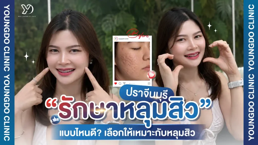 รักษาหลุมสิว ปราจีน แบบไหนดี? เลือกวิธีให้เหมาะกับประเภทหลุมสิว