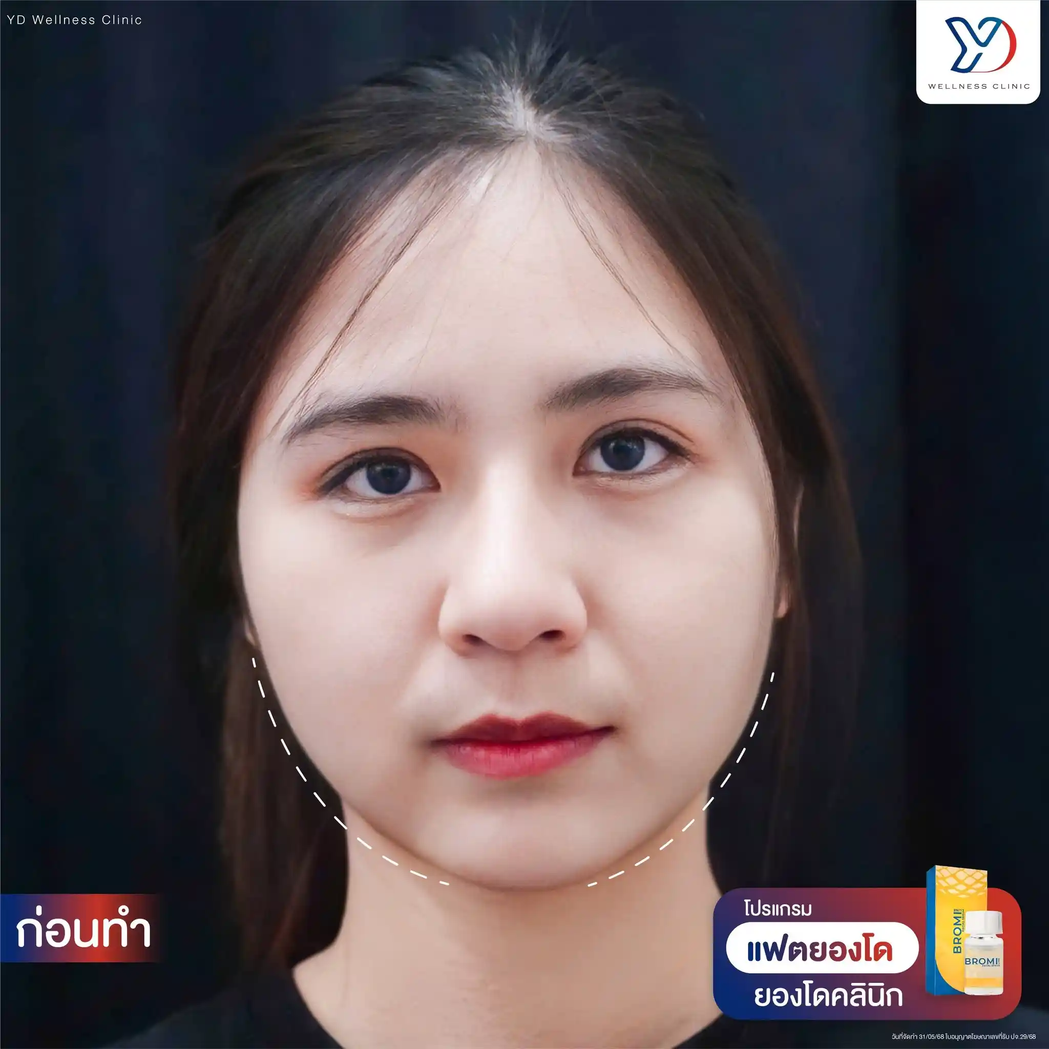 แฟต Bromi สระแก้ว ช่วยลดไขมันบริเวณไหนได้บ้าง