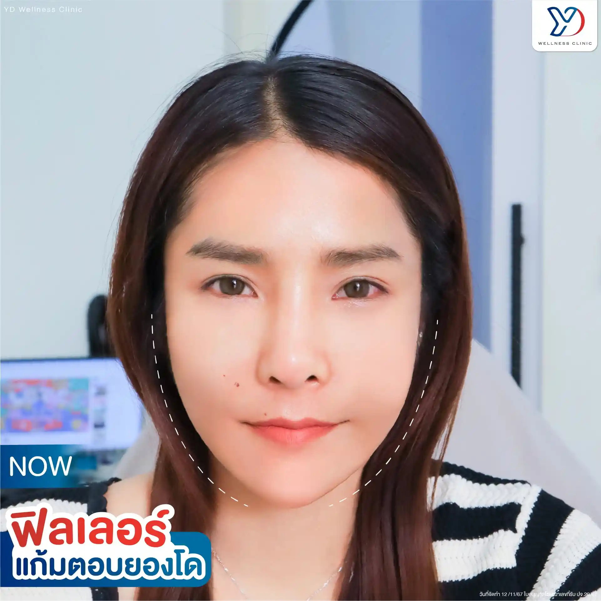 การฉีดโปรแกรมฟิลเลอร์แก้มตอบ ช่วยเรื่องอะไรบ้าง