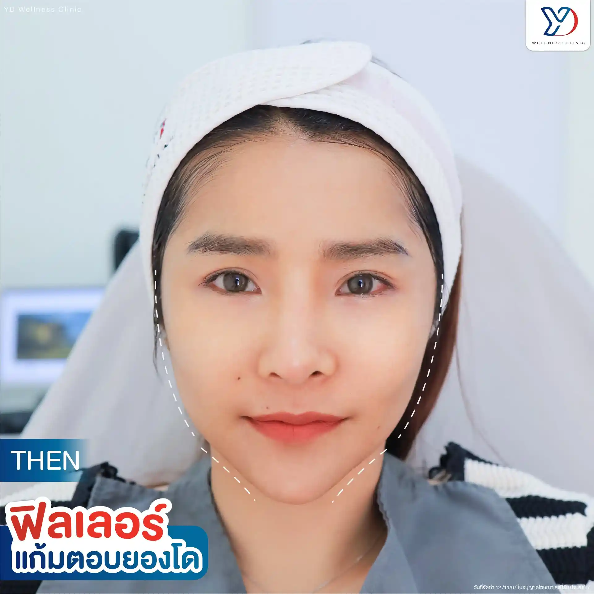 การฉีดโปรแกรมฟิลเลอร์แก้มตอบ ฉะเชิงเทรา เหมาะกับใครบ้าง
