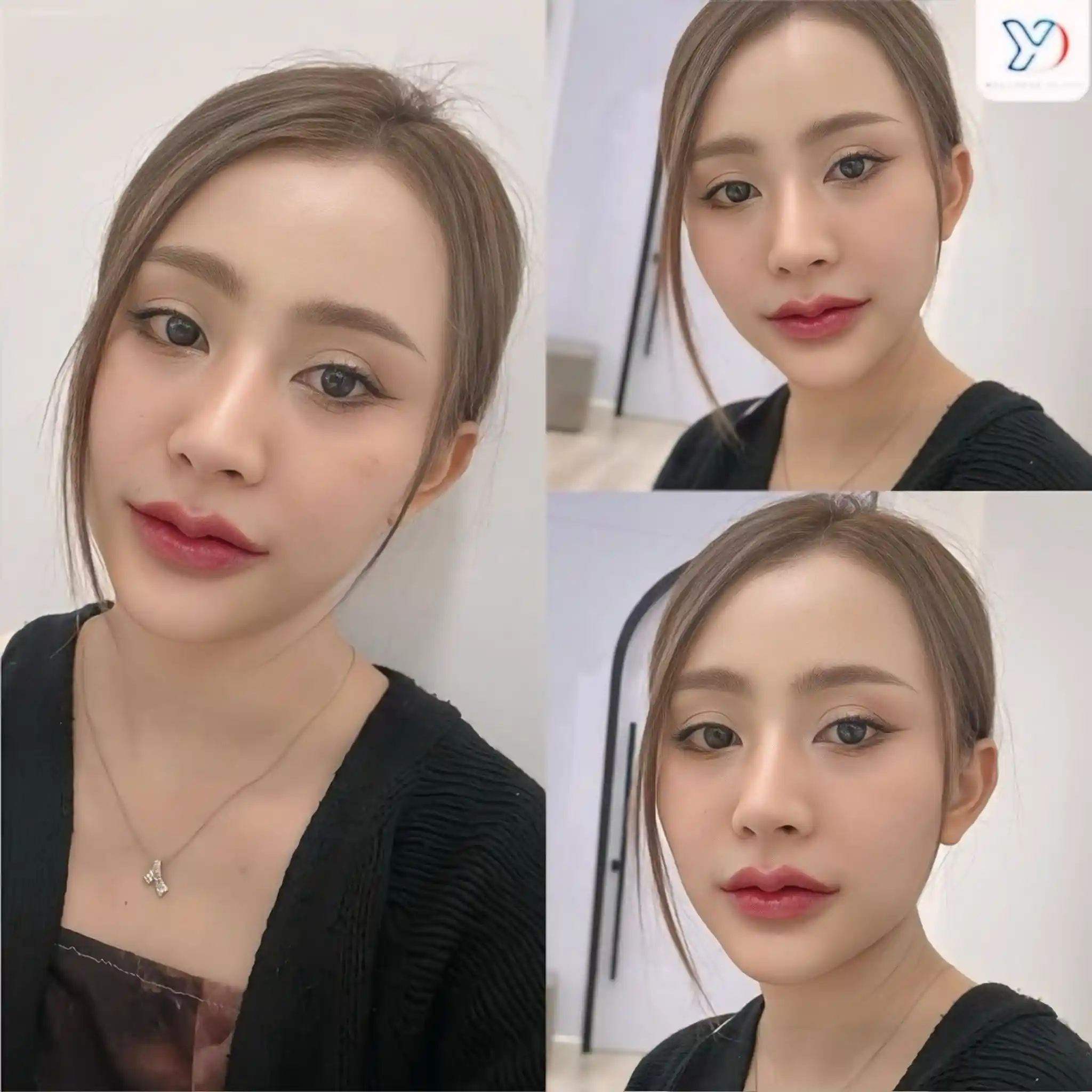 ฟิลเลอร์แก้มส้ม ช่วยให้ใบหน้าแลดูอ่อนเยาว์ขึ้น