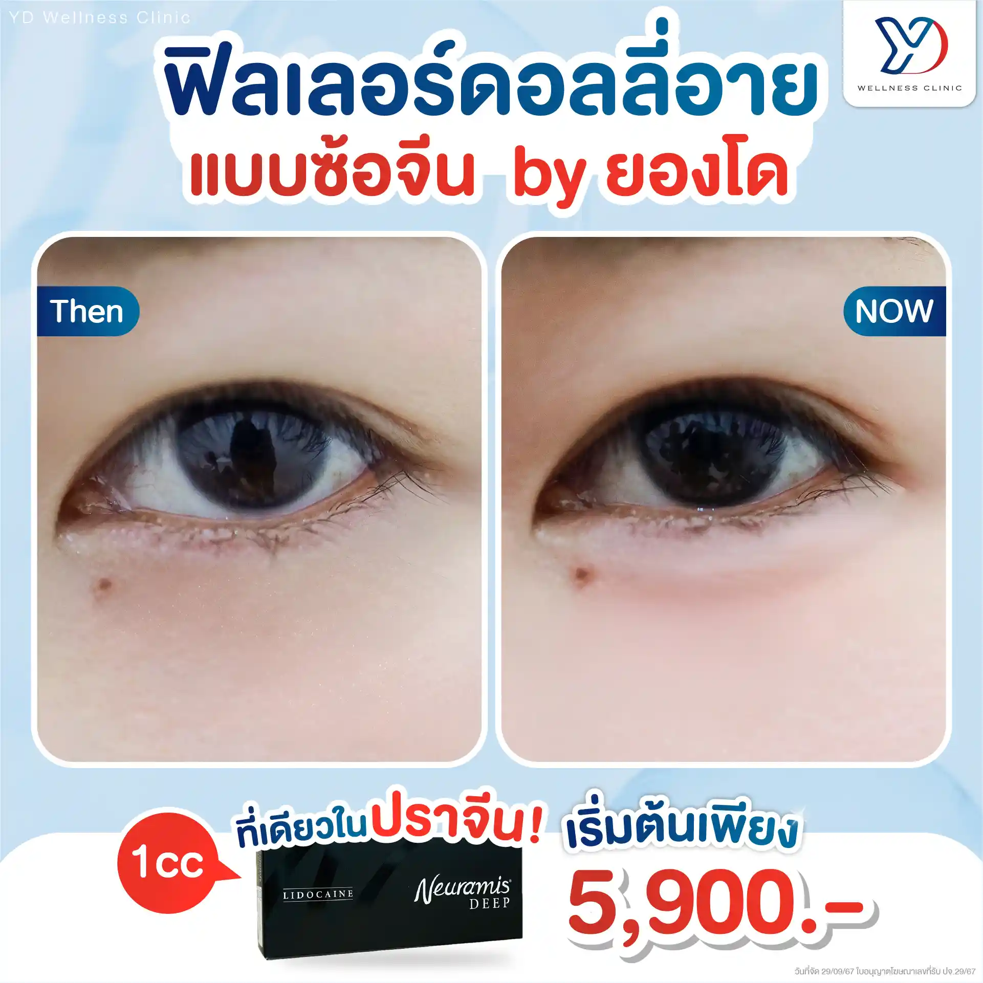 การฉีดดอลลี่อาย มีวิธีไหนบ้าง