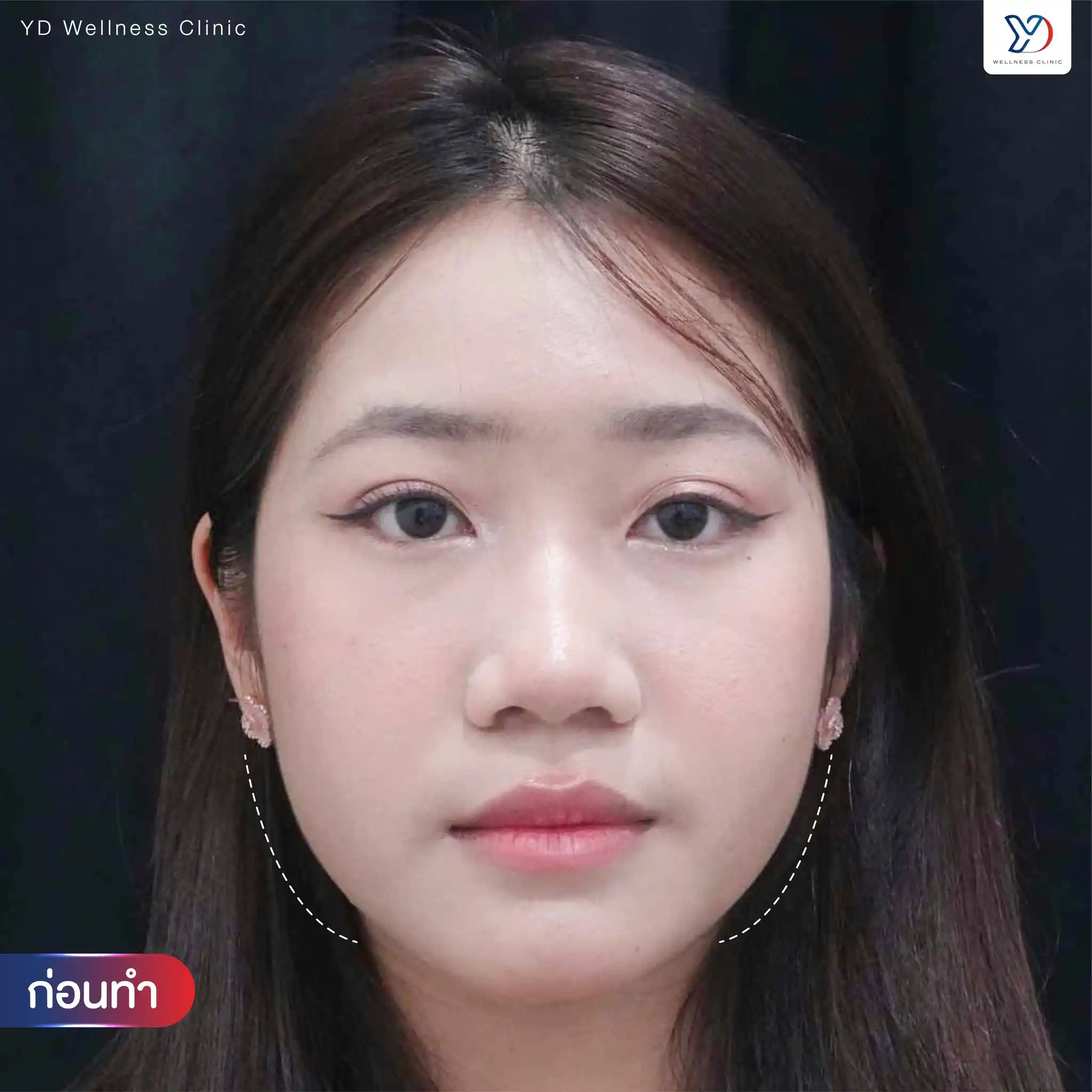 เทรนด์หน้ายุง ปราจีน