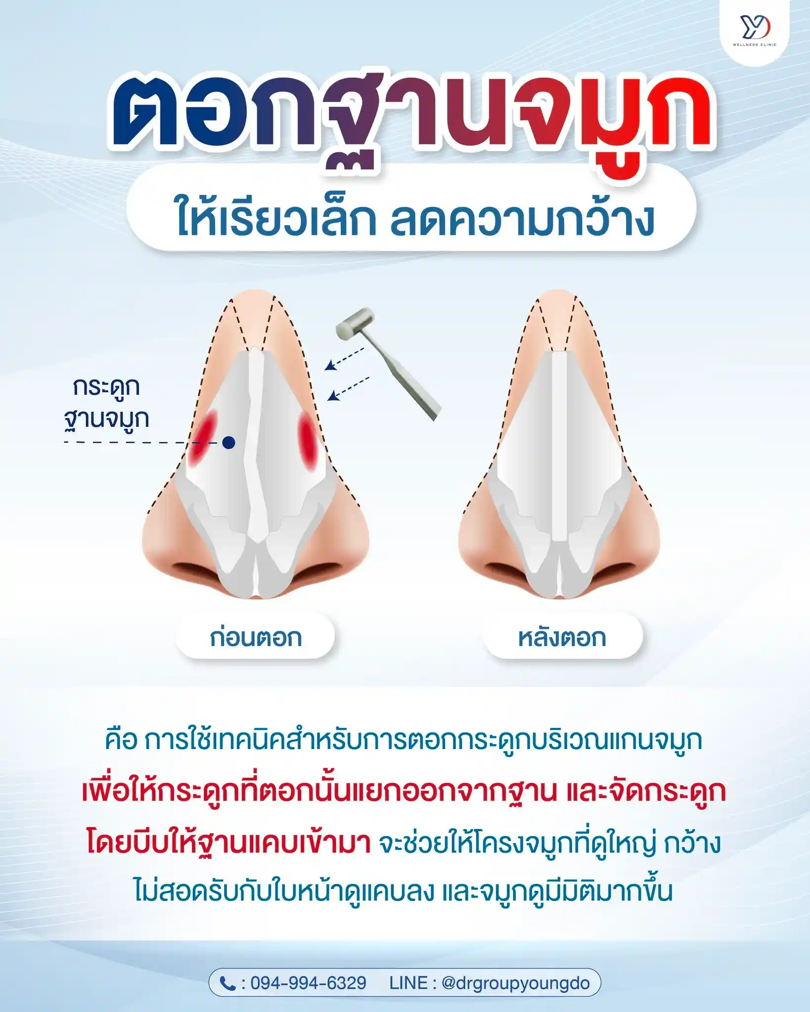 วิธีแก้ไขฮัมพ์จมูก ทั้งแบบผ่าตัดและไม่ผ่าตัด