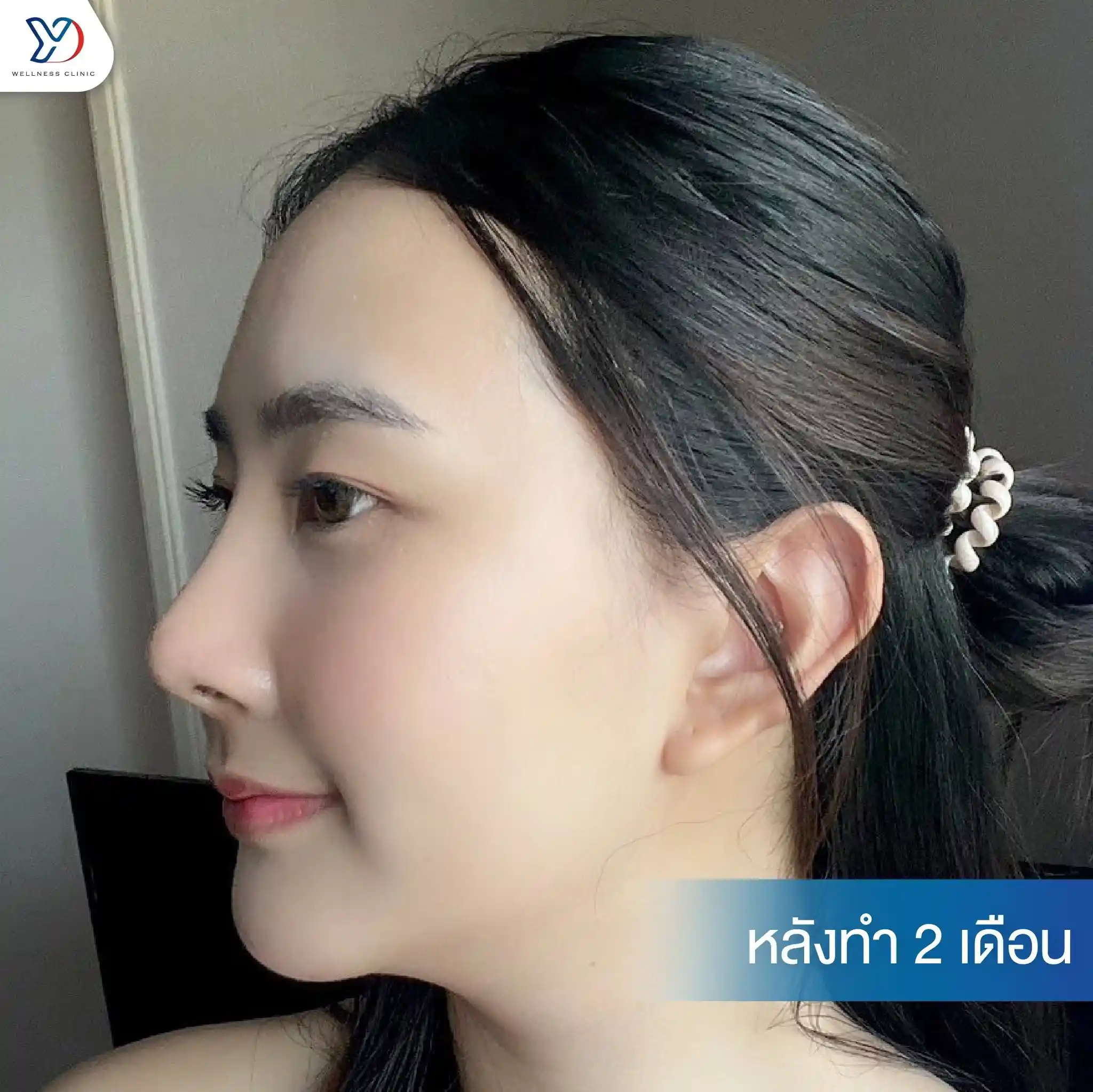 การเตรียมตัวก่อนแก้ฮัมพ์จมูก และการดูแลตัวเองหลังทำ