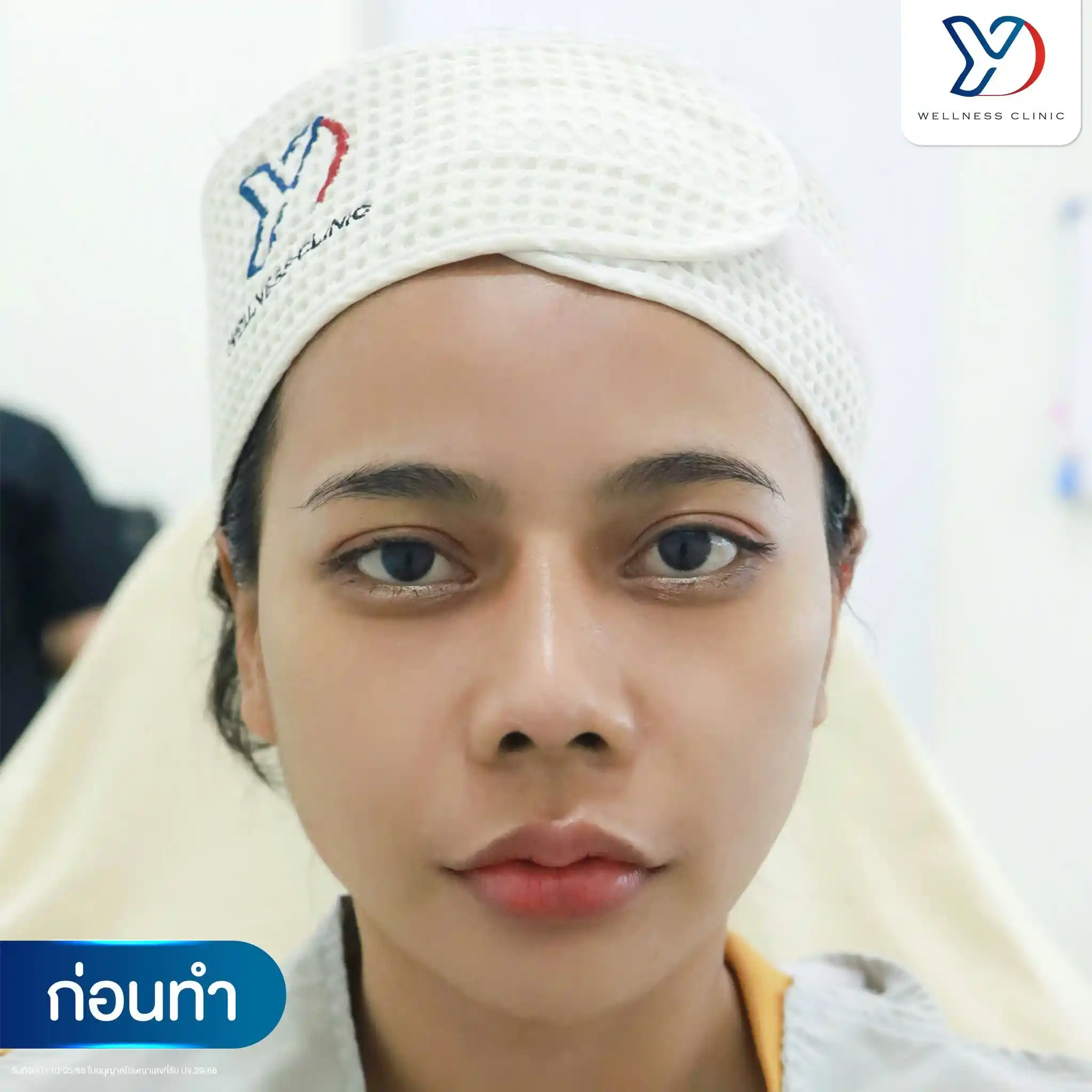 จุดยอดนิยมในการฉีดฟิลเลอร์ Flore