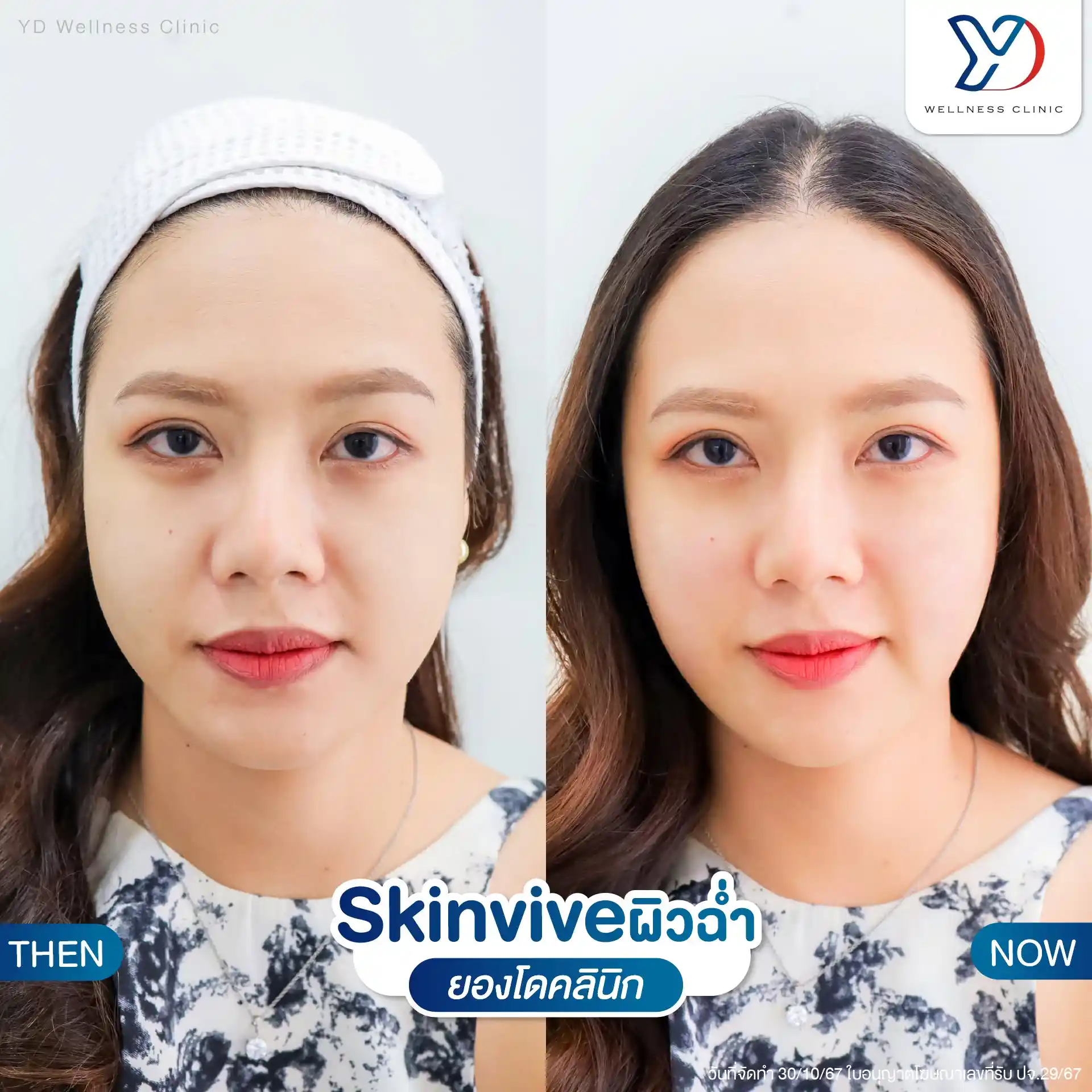 บริเวณไหนที่นิยมฉีด Skinvive
