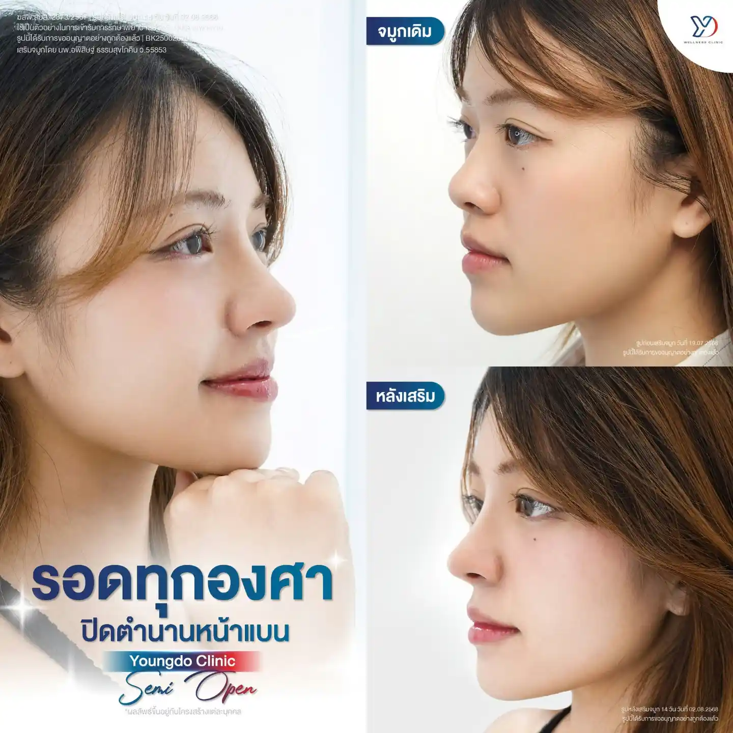 ข้อดีและข้อจำกัดของการเสริมจมูกเทคนิค Semi Open