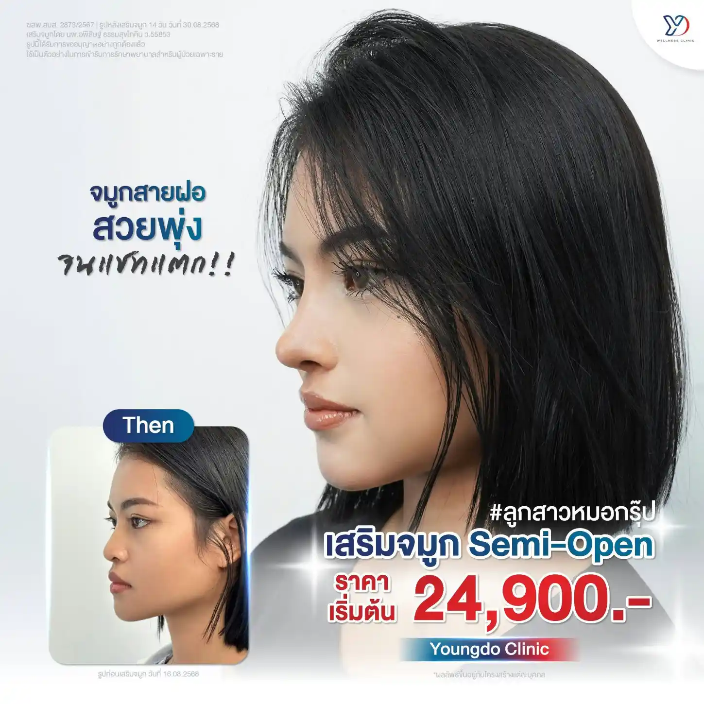 เสริมจมูก Semi Open สระแก้ว ราคาเท่าไหร่