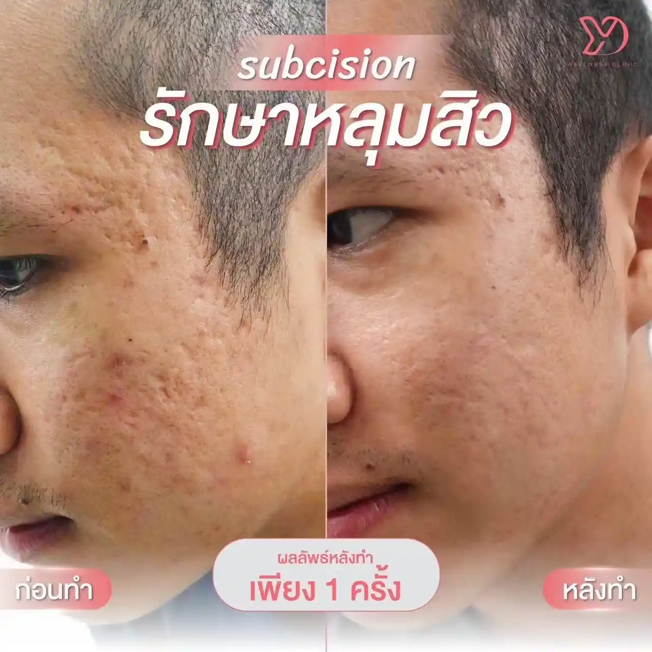 หลุมสิว คืออะไร