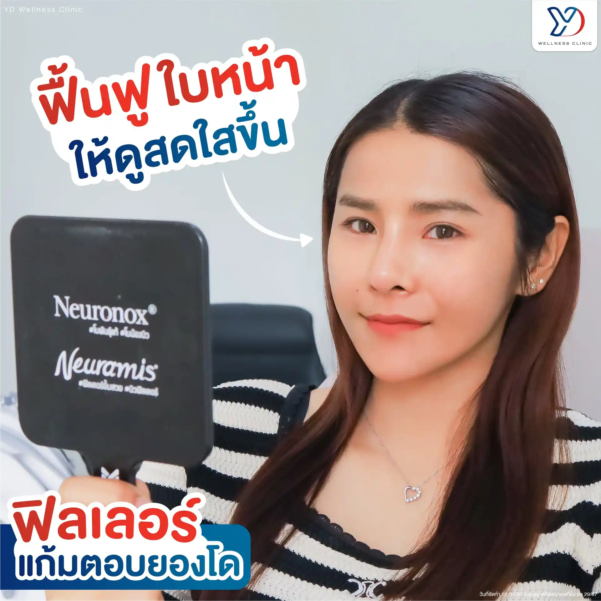 ฟิลเลอร์แก้มตอบ คืออะไร